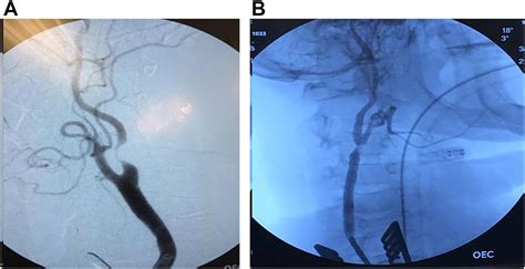 What Is the Role of Transcarotid Artery Revascularization? - Advances in Surgery