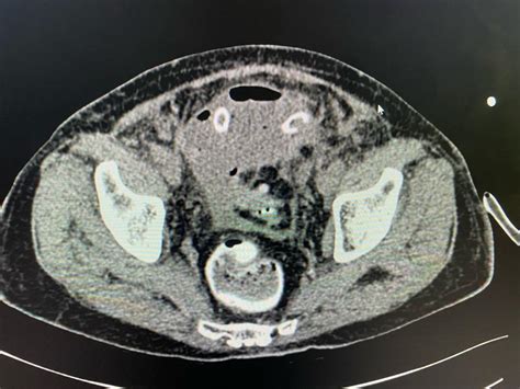 Diverticulitis - Challenging Situations in Colonic Diverticulitis: Case ...