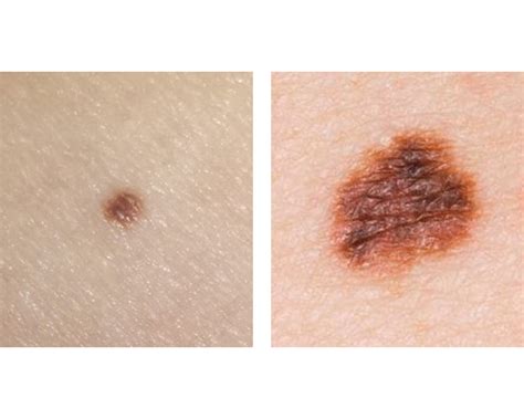 Remember your ABCDEs – Skin Cancer Awareness - CellDerma USA