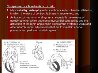 Image result for Heart Failer Compensatory Processes