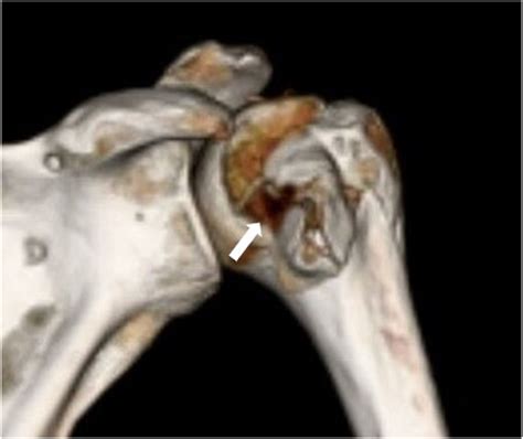 Anatomic Reconstruction of a Large Reverse Hill-Sachs Lesion After ...