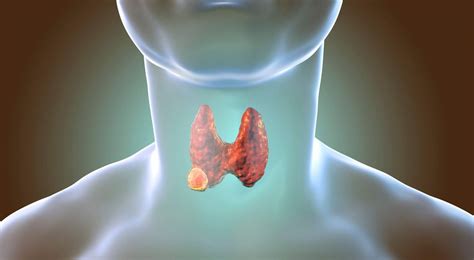 Can Hyperthyroidism Cause Headaches?