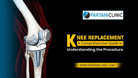 When To Use Heat After Knee Replacement at Erik Rangel blog