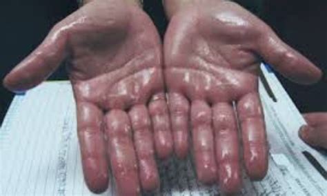 Needle-Free Botulinum Toxin Injections: A Less Painful and Effective ...