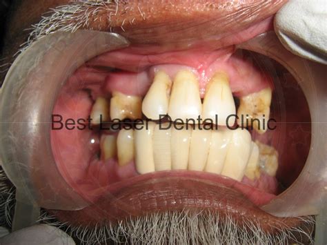 » gallery 4-All upper teeth replacement with basal implants which is ...