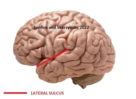 Image result for Sulcus Sign Lateral View