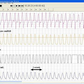 Image result for Carbon Monoxide Diffusing Capacity Test