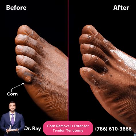 Corn Removal Surgery Before and After Photos - Luxe Foot Surgery