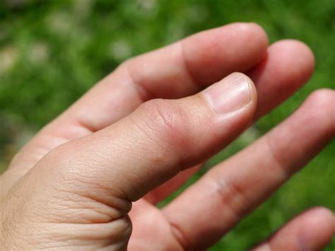 Home Remedies: Just jammed your finger? | Jammed finger, Finger injury ...