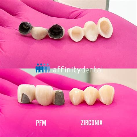 PFM vs Zirconia Crowns and Bridges | What is best?