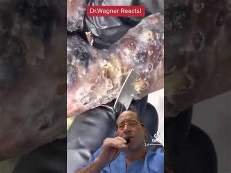 Jigger Fleas Remove 的图像结果