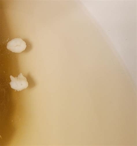 Can anyone identify these white clumps in my stool? Sometimes they ...