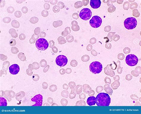 Frotis Sanguínea Que Muestra Leucemia Mieloide Aguda De Adultos Foto de ...