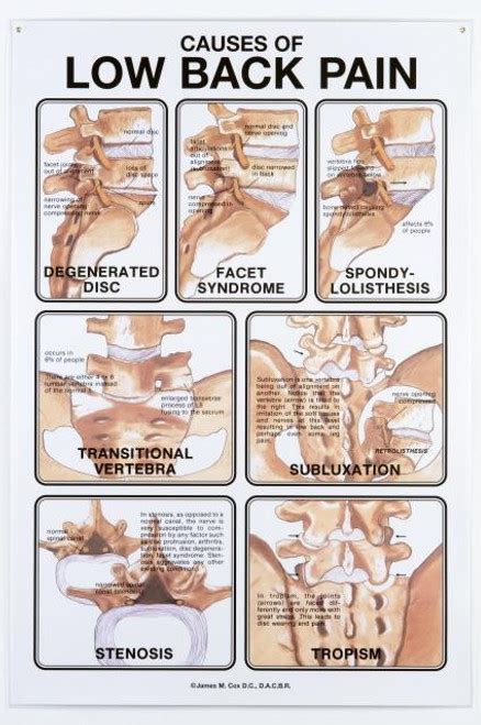 Image result for Lower Back Pain Chart