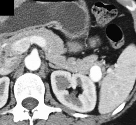Splenic Artery Aneurysm Xray
