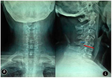 Image result for Contralateral View