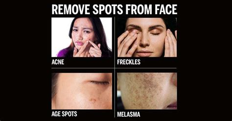 How To Remove Spots From Face | Femina.in