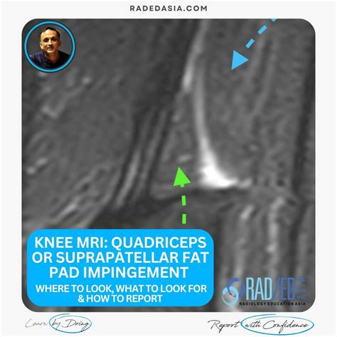 KNEE FAT PAD IMPINGEMENT MRI: QUADRICEPS OR SUPRAPATELLAR FAT PAD IMPINGEMENT (VIDEO ...