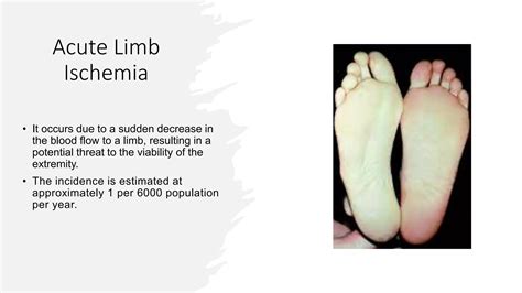 Acute Limb Ischemia | PPSX