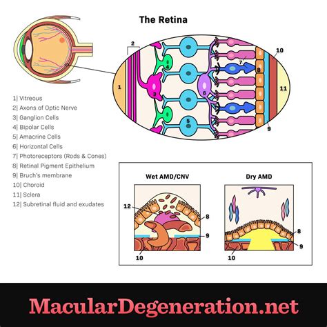 Wet Amd Vs Dry Amd