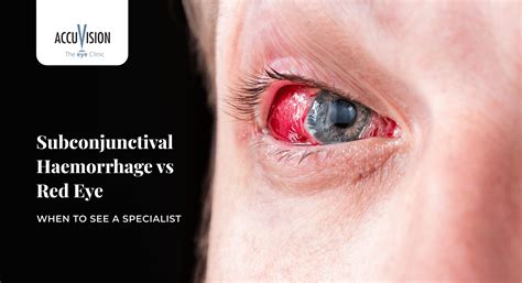 Subconjunctival Hemorrhage vs Red Eye: Causes, Symptoms, and When to See a Specialist