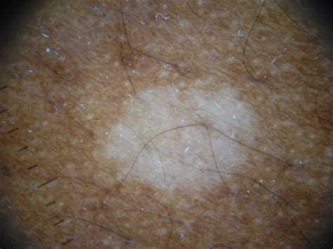 White Spots On Skin Yeast at Clair Azevedo blog