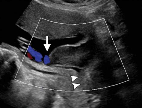 Bildergebnis für velamentous umbilical cord ultrasound