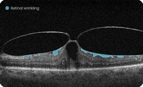Image result for Eye Diseases Google Engineer Machine Learning