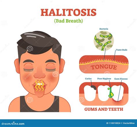 Halitosis. Bad Breath Vector Illustration Diagram Poster. Stock Vector - Illustration of care ...