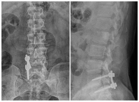 Recurrent Spinal Canal Stenosis after Decompression and Fusion Surgery ...