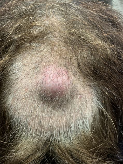 Hard Bump On Head Cyst