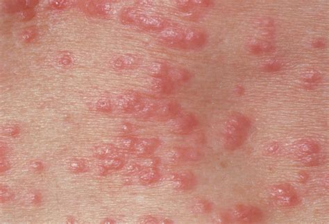 Which Skin Cream Takes Care of Rashes and Bug Bite – Bipha Ayurveda