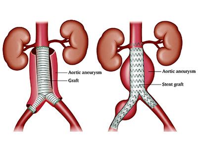 Aneurysms Treatment in Thane | Dr. Ritesh Gaikwad