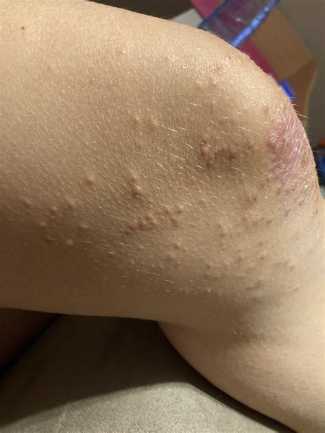 Red itchy bumps on knee : r/medical