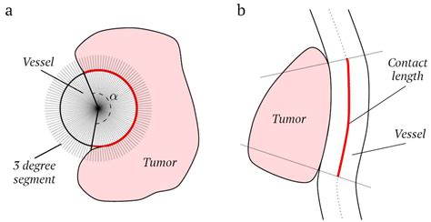 Computed Tomography-Based Radiomics Using Tumor and Vessel Features to Assess Resectability in ...