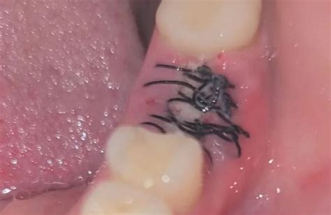 Dissolvable Stitches Hanging in Mouth | Medico Sutures