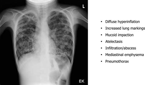 Barrel Chest Copd Emphysema