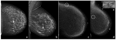Diagnostic Performance of Contrast-Enhanced Digital Mammography versus Conventional Imaging in ...