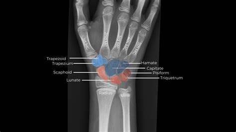 Wrist Anatomy Carpal Bones