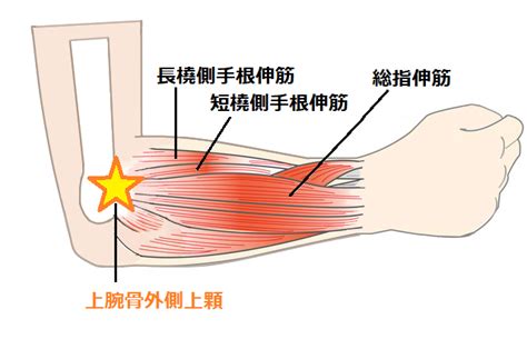 テニス肘（外側上顆炎）｜ダエンからマル Lab.（ラボラトリー）｜ダエンからマル施術院