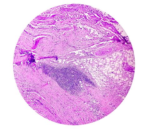 Cyst Thyroglossal Duct