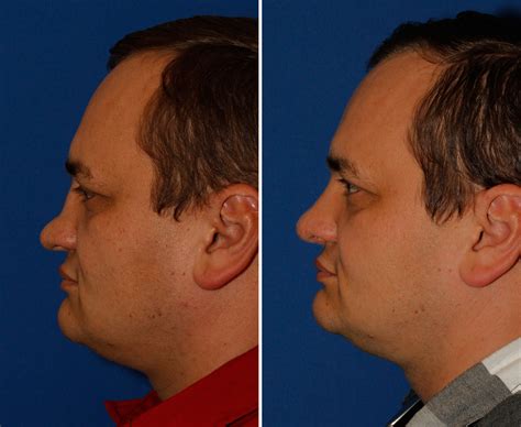 Saddle Nose Deformity | Rhinoplasty in Seattle