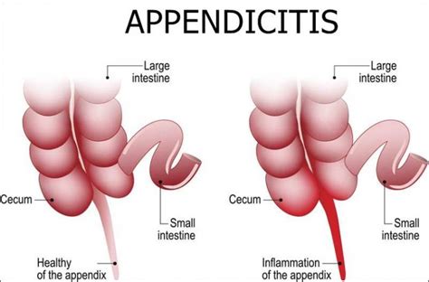 Image result for Appendix Example Website