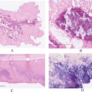 Image result for Devitalized Tissue Example