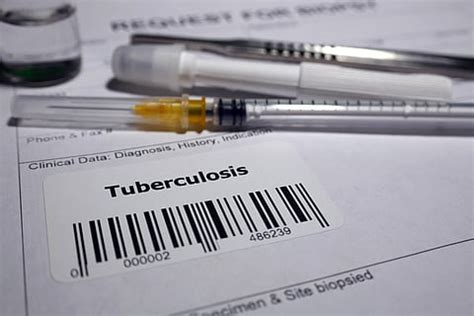 India's TB Challenge: National Plan Nears Deadline, Progress Lags