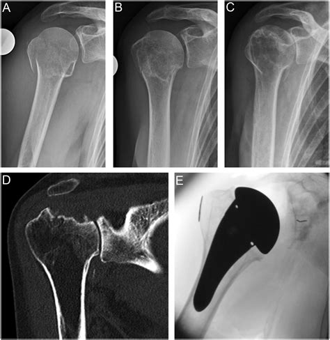 Proximal Humerus Fracture X Ray