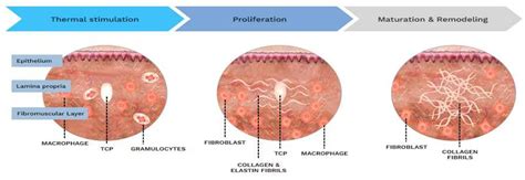 Evaluating the Efficacy of the More Young HIFU Device for Facial Skin ...