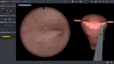 Diagnostic Hysteroscopy - Surgical Science