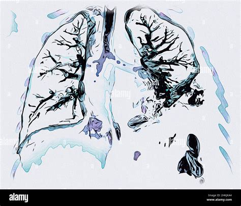 Lung affected by pneumonia, CT scan Stock Photo - Alamy