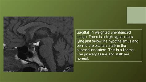 Pituitary gland MRI | PPTX